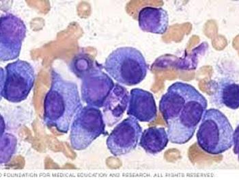 پیوند سلول های بنیادی خون ساز بقای بیماران مبتلا به مولتیپل میلوما را بهبود می بخشد