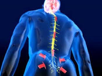 ایمپلنت های الکتریکی علایم مشهود آسیب نخاعی را در مردان کاهش می دهد