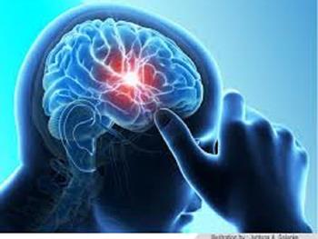 درمان های مبتنی بر سلول های بنیادی برای سکته، بافت مغزی را ترمیم می کنند