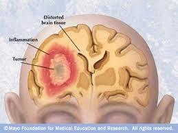 شناسایی درمانی بالقوه برای سرطان مغز