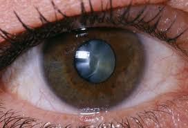 سلول های بنیادی ‌و بازسازی عدسی چشم در کاتاراکت
