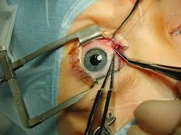 داروی ترمیم کننده ای که به روند بهبود بافت چشم بعد از جراحی سرعت می بخشد