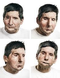 طراحی ایمپلنت های حاوی آنتی بیوتیک برای بازسازی چهره