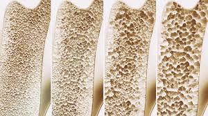 موافقت FDA با استفاده از نوعی پلیمر برای کمک به رشد مجدد استخوان