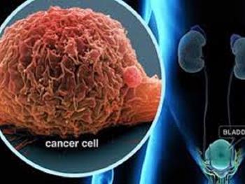 شناسایی منشا سلولی سرطان تهاجمی مثانه