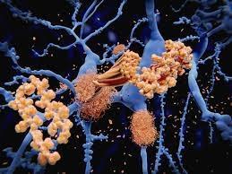 چگونه کلسترول مغز پلاک‌های آلزایمر را تنظیم می کند؟