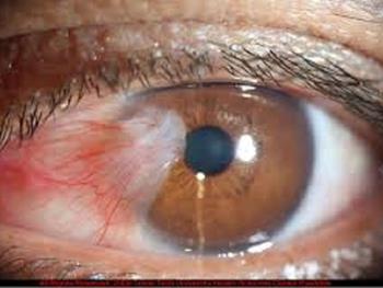 نیکوتین آمید می تواند به درمان بیماری چشمی فیبروز و کاهش نابینایی کمک کند