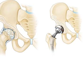 کاهش نیاز به جراحی تعویض مفصل ران با کمک سلول‌های بنیادی 