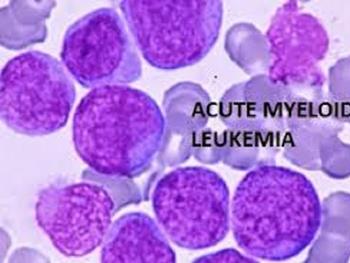 راهی برای مقابله با سلول های بنیادی سرطانی در لوکمیای میلوئید حاد 