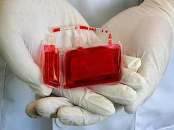 درمان بیماری سپسیس با سلول‌های بنیادی خون بندناف 