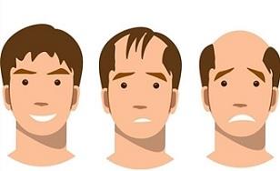 ارتباط ژن‌های نادر با ریزش موی مردانه ارثی 