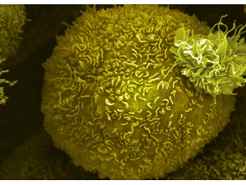 ایجاد ارگانوئیدهای جدید سرطان پانکراس برای غربالگری موثر دارو