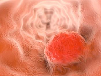 سلول‌های بنیادی و سرطان‌های کشنده گوارشی