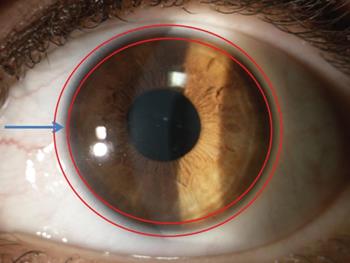 سلول‌های بنیادی بالغ در چشم: تشخیص، شناسایی، و کاربرد درمانی در بازسازی چشم 