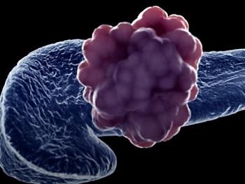 سلول‌های مقاوم به استرس باعث شروع تومور در سرطان پانکراس می‌شوند
