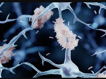 نقش یک پروتئین در کاهش زوال عقل در بیماران آلزایمری 
