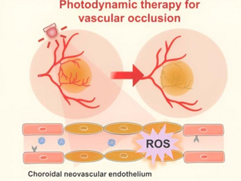 درمان دژنراسیون ماکولا با نانوداروهای فعال کننده نور