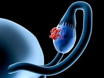 ایمونوتراپی جدید نویدبخش سرطان تخمدان 