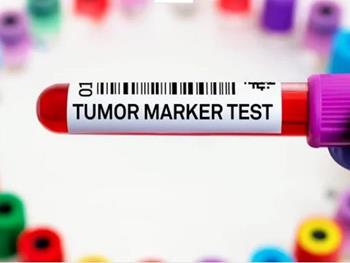 تشخیص بیومارکر چند نوع سرطان با یک آزمایش خون فوق حساس